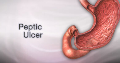 Doctors may soon diagnose peptic ulcer & disease stage by recognising breath patterns